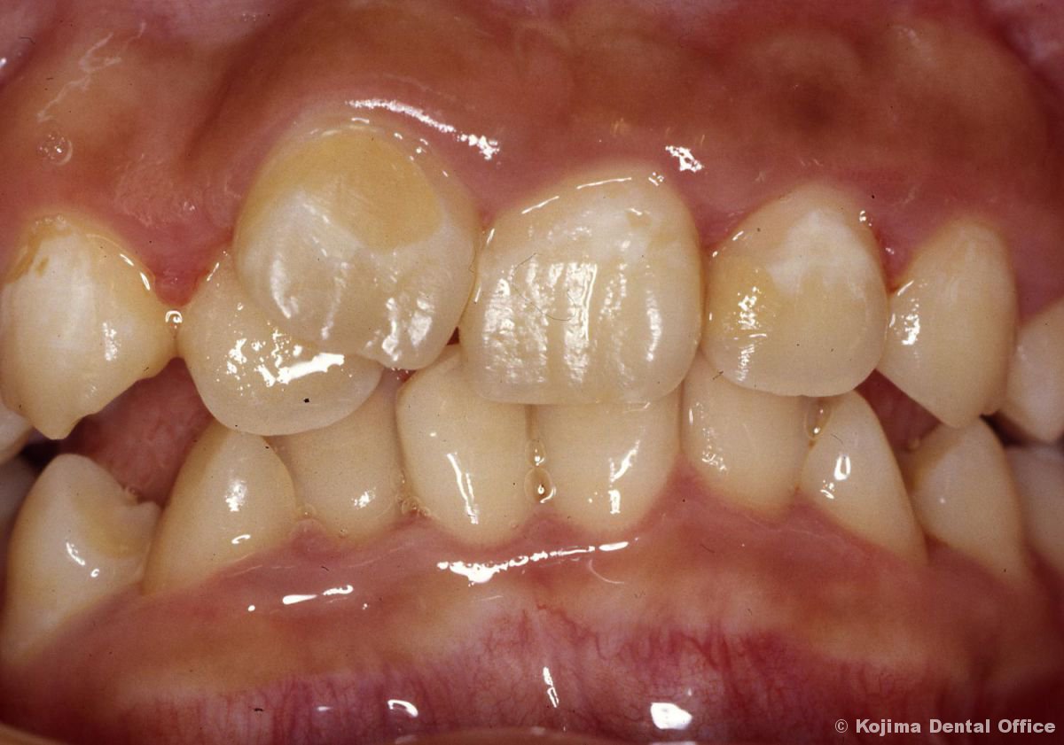 エナメル質初期う蝕 小島歯科医院 石川県内灘町 口の健全な育成 歯周治療 インプラント治療 訪問診療