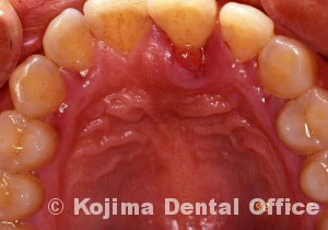 歯周炎の歯肉変化