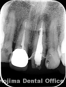 歯根の内部吸収７