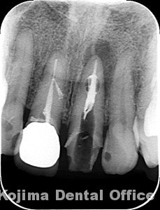 歯根の内部吸収８
