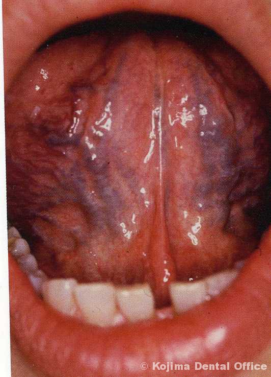 舌 の 裏 血管 写真