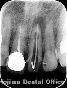 歯根の内部吸収６